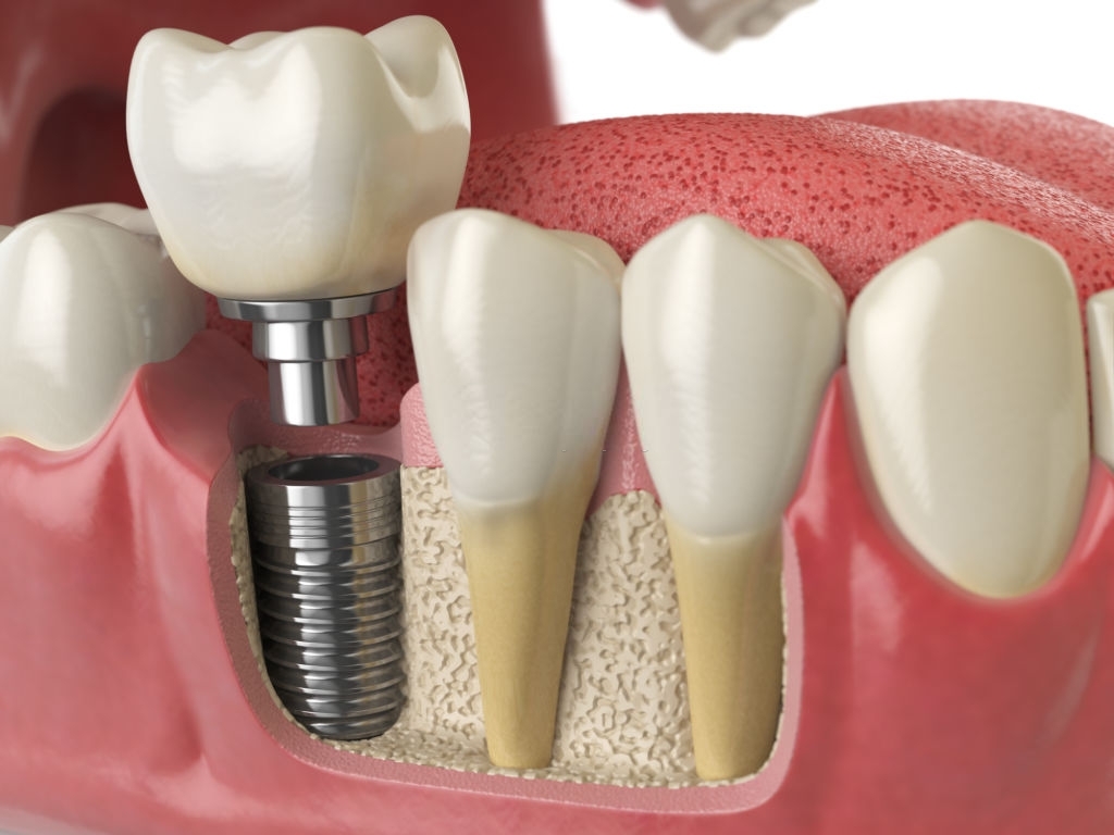 Dental Implants: Why They Are The Best Solution For Damaged Teeth