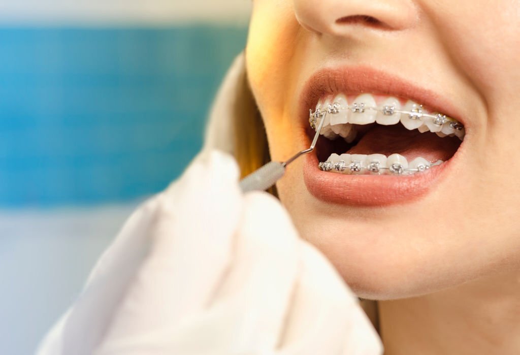 Orthodontics For Adults