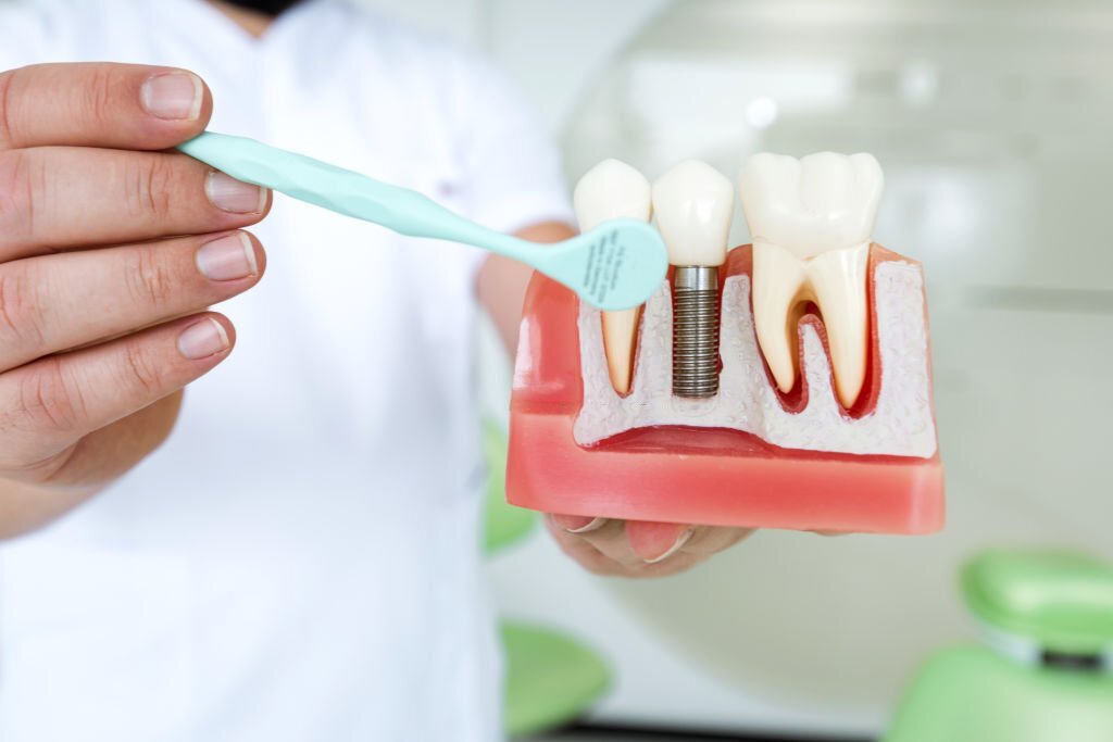 Dental Implants: What You Should Know