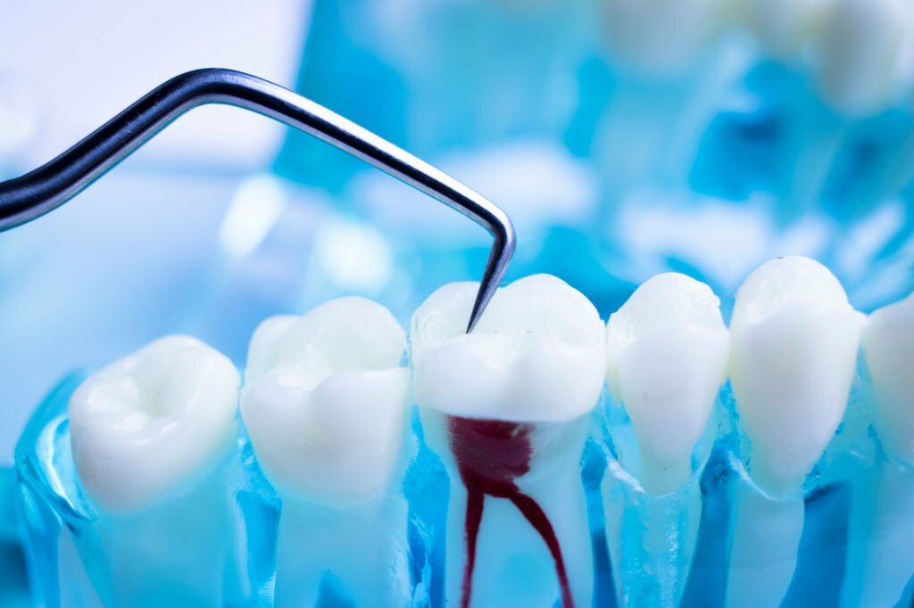 A Comprehensive Guide to Dentistry for Root Canals_FI