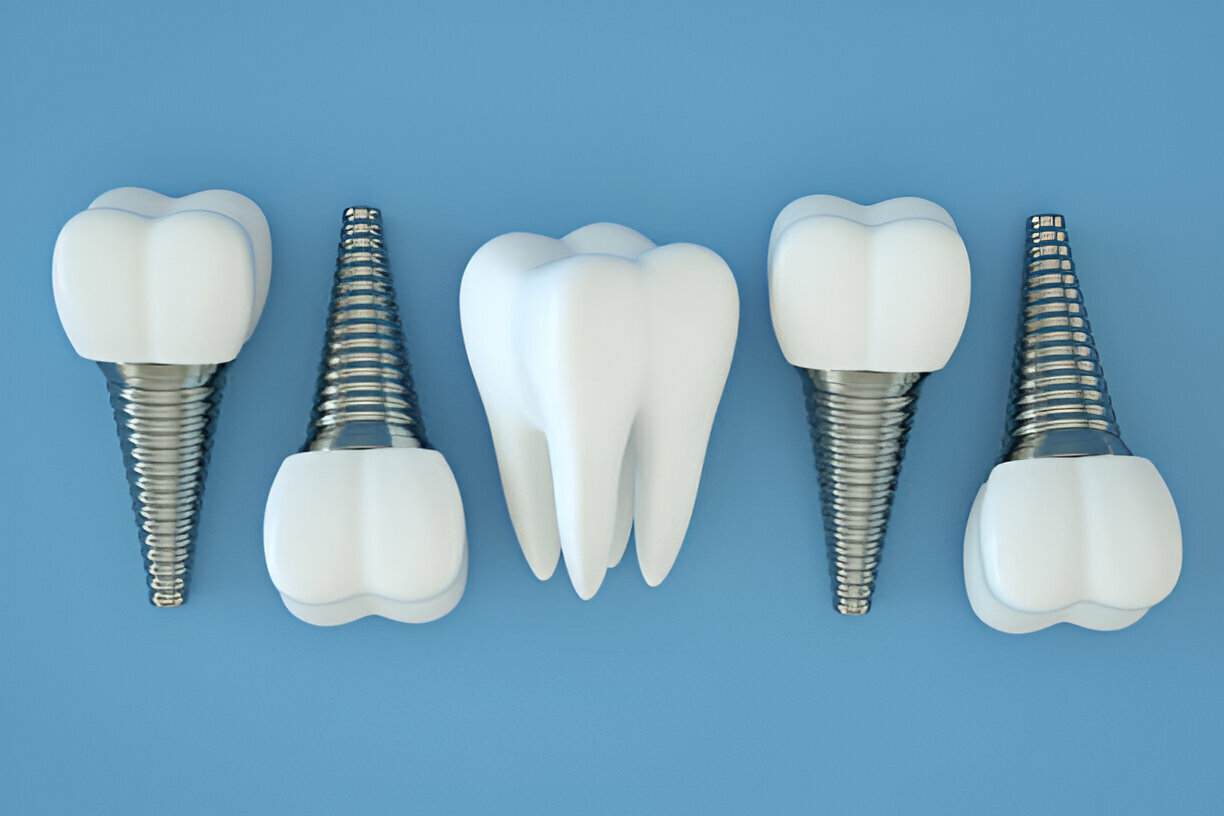 Dental Implant Risks: Common Issues and Their Solutions_FI