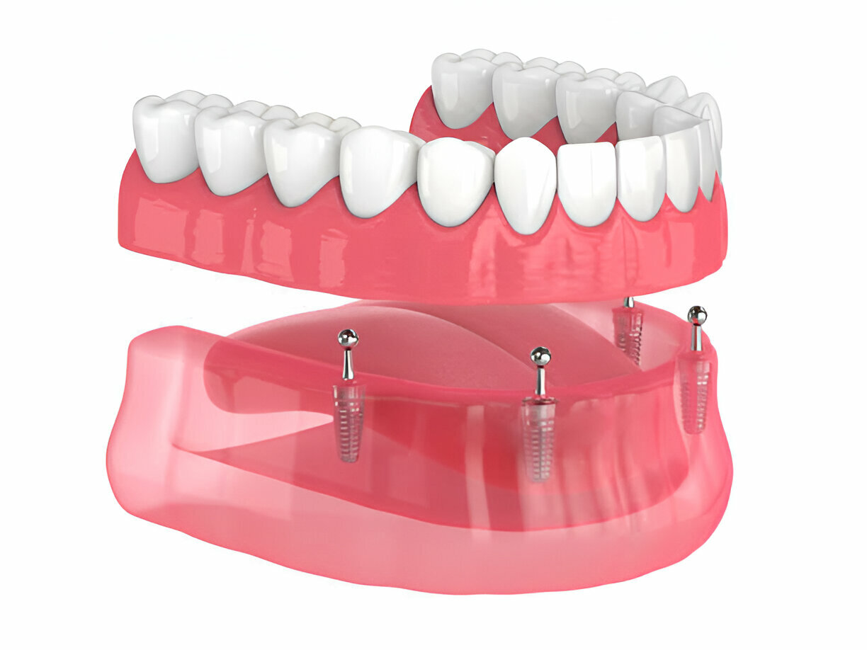 Navarro Dental Center: Your Trusted Provider for Full and Partial Dentures in Corsicana, Texas_FI