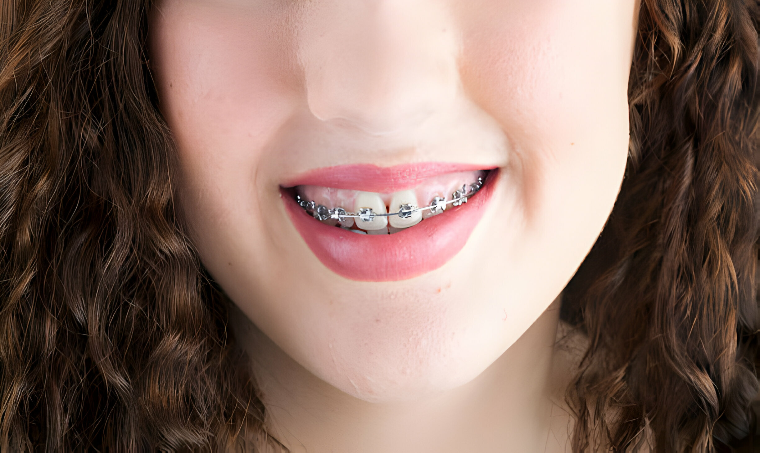 Braces in Corsicana, TX: A Complete Patient Guide to Getting Started_FI